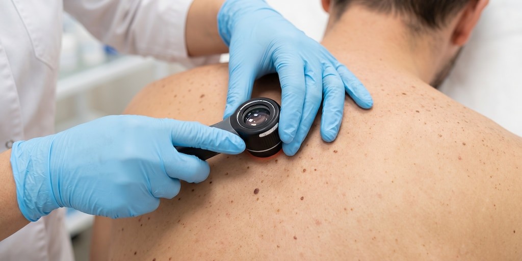 Vacuna de ARNm contra el melanoma: un avance que refuerza la soberanía científica y la salud pública